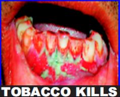 India 2011 Health Effects Mouth (Smokeless Tobacco Products) - diseased mouth, gross